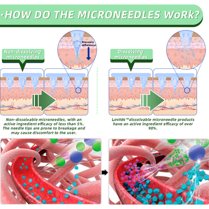 LOVILDS™ SMGT-GLP-1 Nano Microneedle Patch（Painless, long-lasting, addressing diabetes, obesity, and cardiovascular diseases）