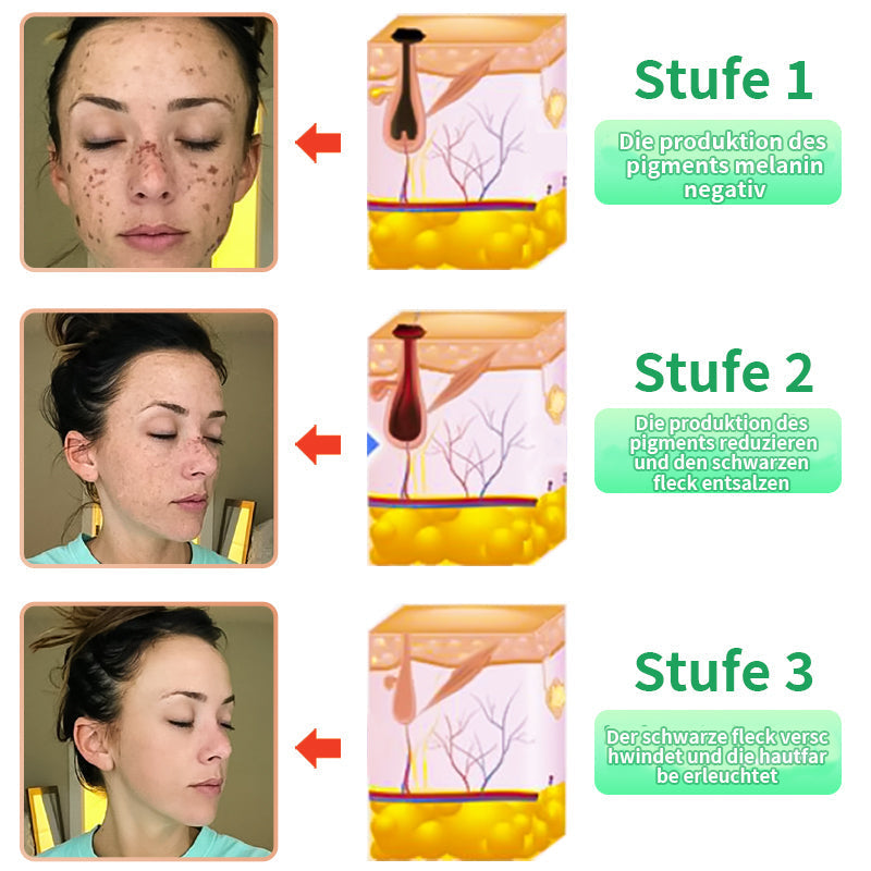 Histone™ Reinigendes Peeling-Gel🍇- für Acanthosis Nigricans, Peeling, dunkle Flecken, Hautflecken und Ekzeme