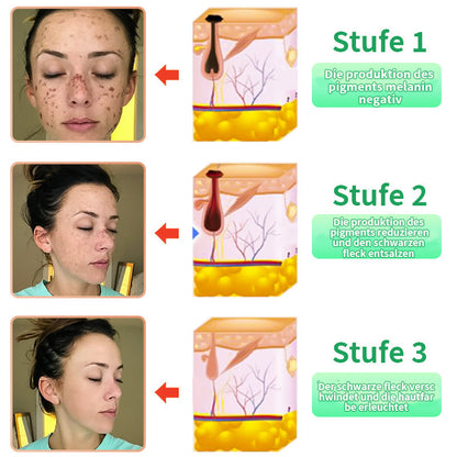 Histone™ Reinigendes Peeling-Gel🍇- für Acanthosis Nigricans, Peeling, dunkle Flecken, Hautflecken und Ekzeme