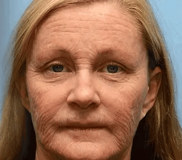 🔥Last 3 Hours! 70% OFF:Cougex™ Retinal Shot Tightening Booster- Eraser for Deep Wrinkles, Sagging Jowls & Puffy Eyes