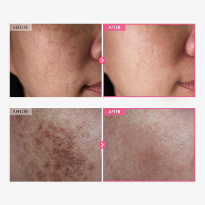 Cougex™ Arbutin 7% + Tranexamic Acid 4% Cream ： Rediscover Radiant, Even-Toned Skin